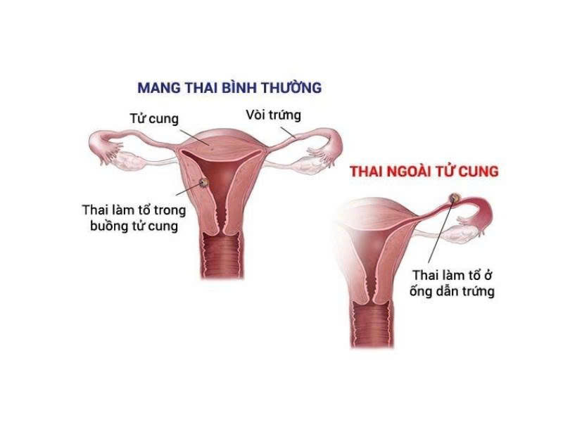 So sánh mang thai bình thường và mang thai ngoài tử cung