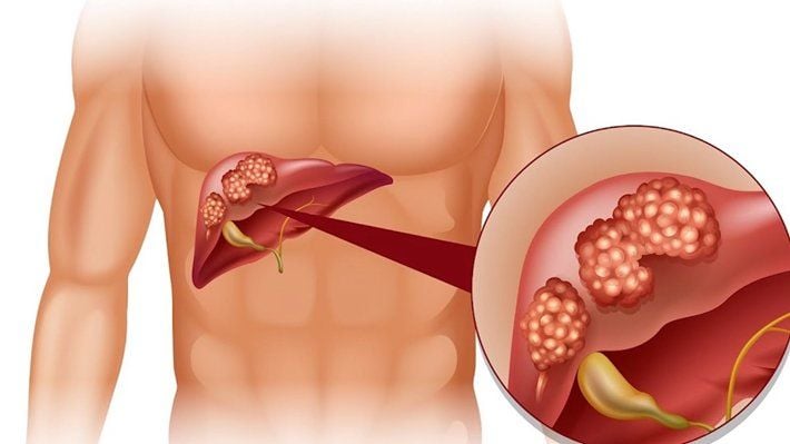 Nguyên nhân chính là do lây nhiễm bởi người đã nhiễm bệnh