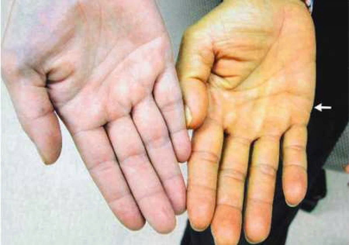 Triệu chứng của người nhiễm bệnh