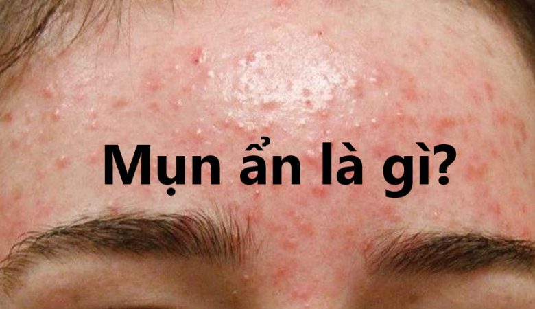 Mụn ẩn là gì?