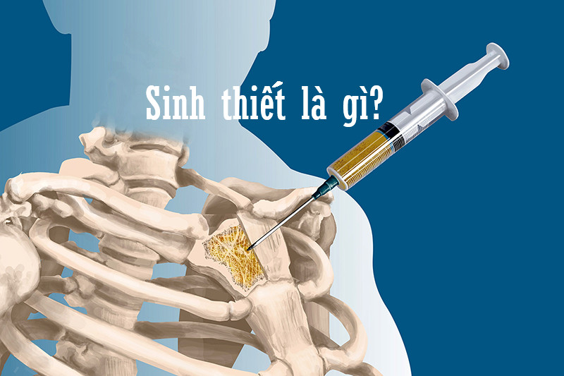 Sinh thiết là gì?