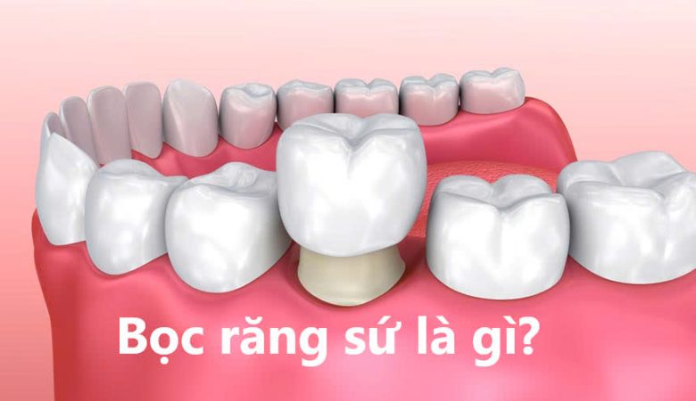 Bọc răng sứ là gì?