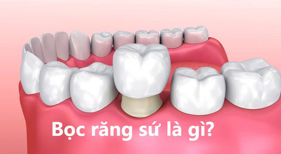 Bọc răng sứ là gì?