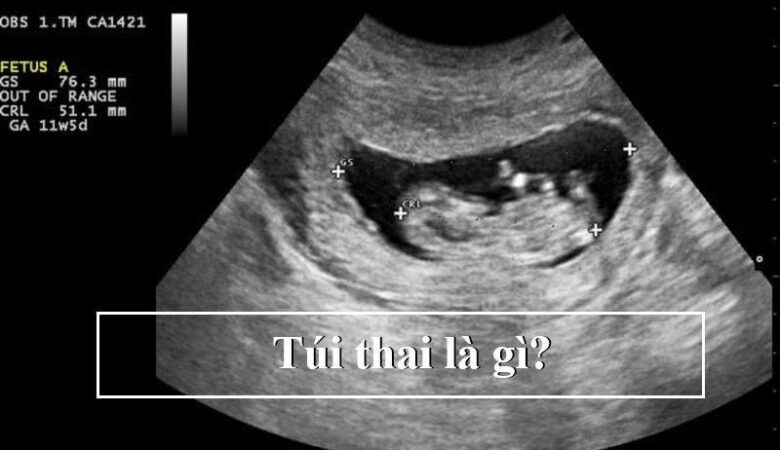 Túi thai là gì?
