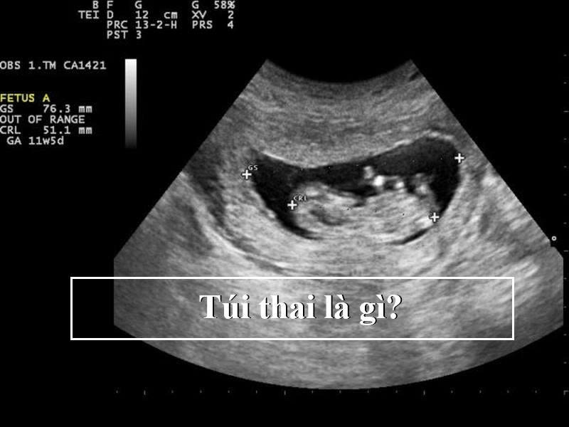 Túi thai là gì?